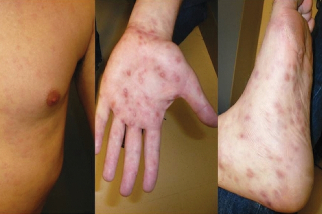 sífilis secundária.jpg